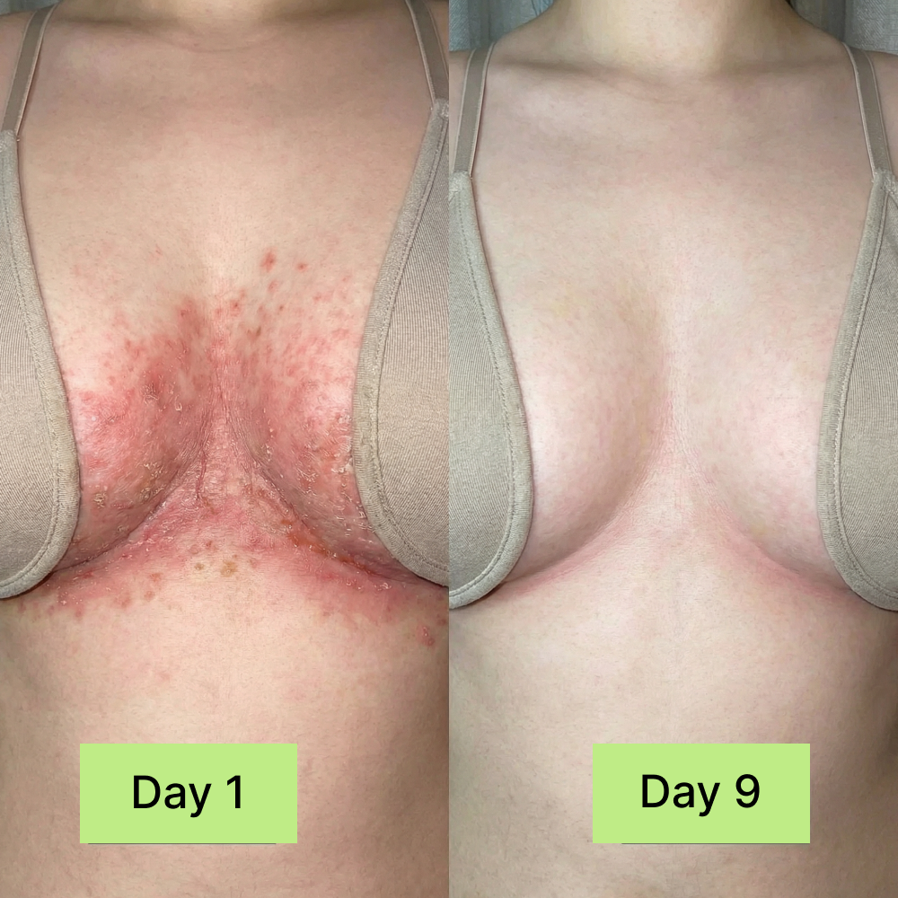 Clinical Antifungal Soap