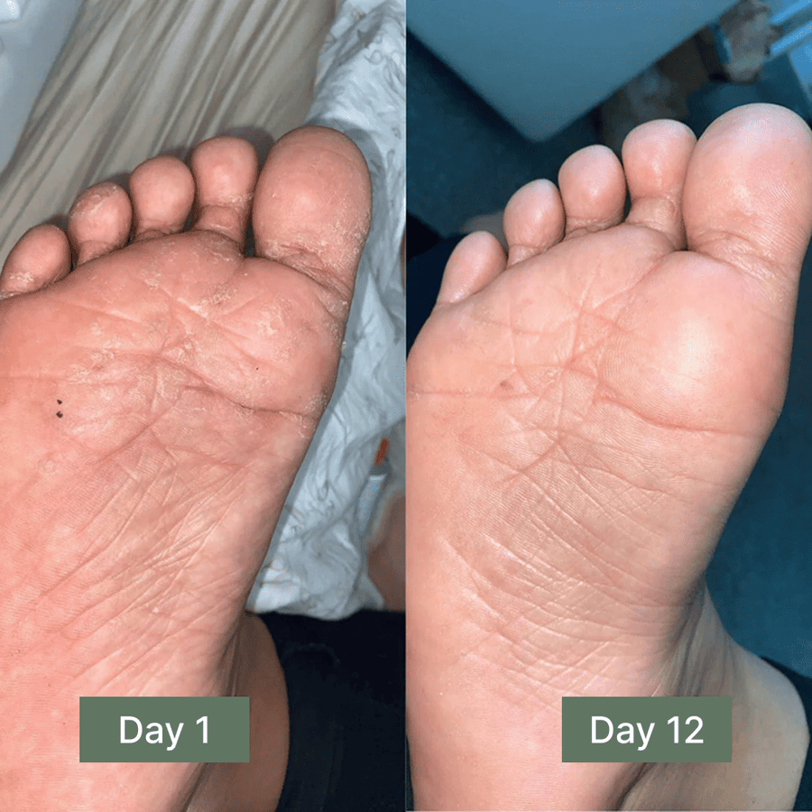 Clinical Antifungal Soap